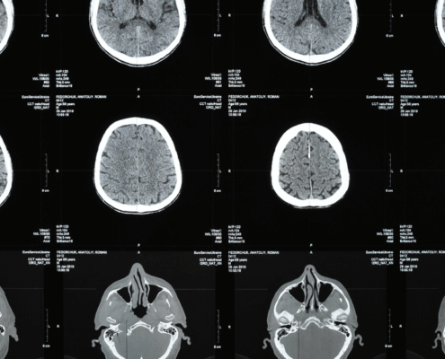 Early Warning Signs of Traumatic Brain Injury After a Mississippi Car Accident