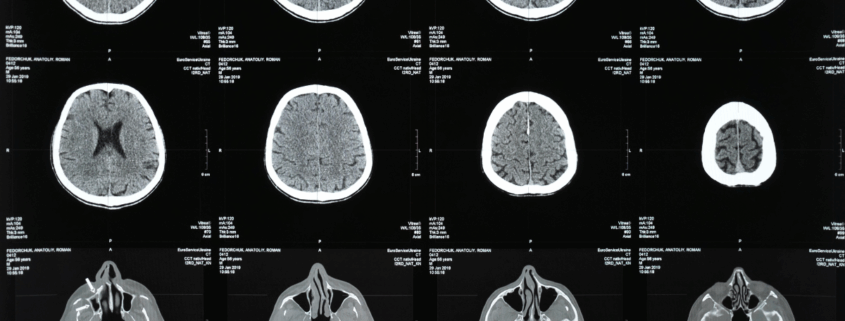 Early Warning Signs of Traumatic Brain Injury After a Mississippi Car Accident